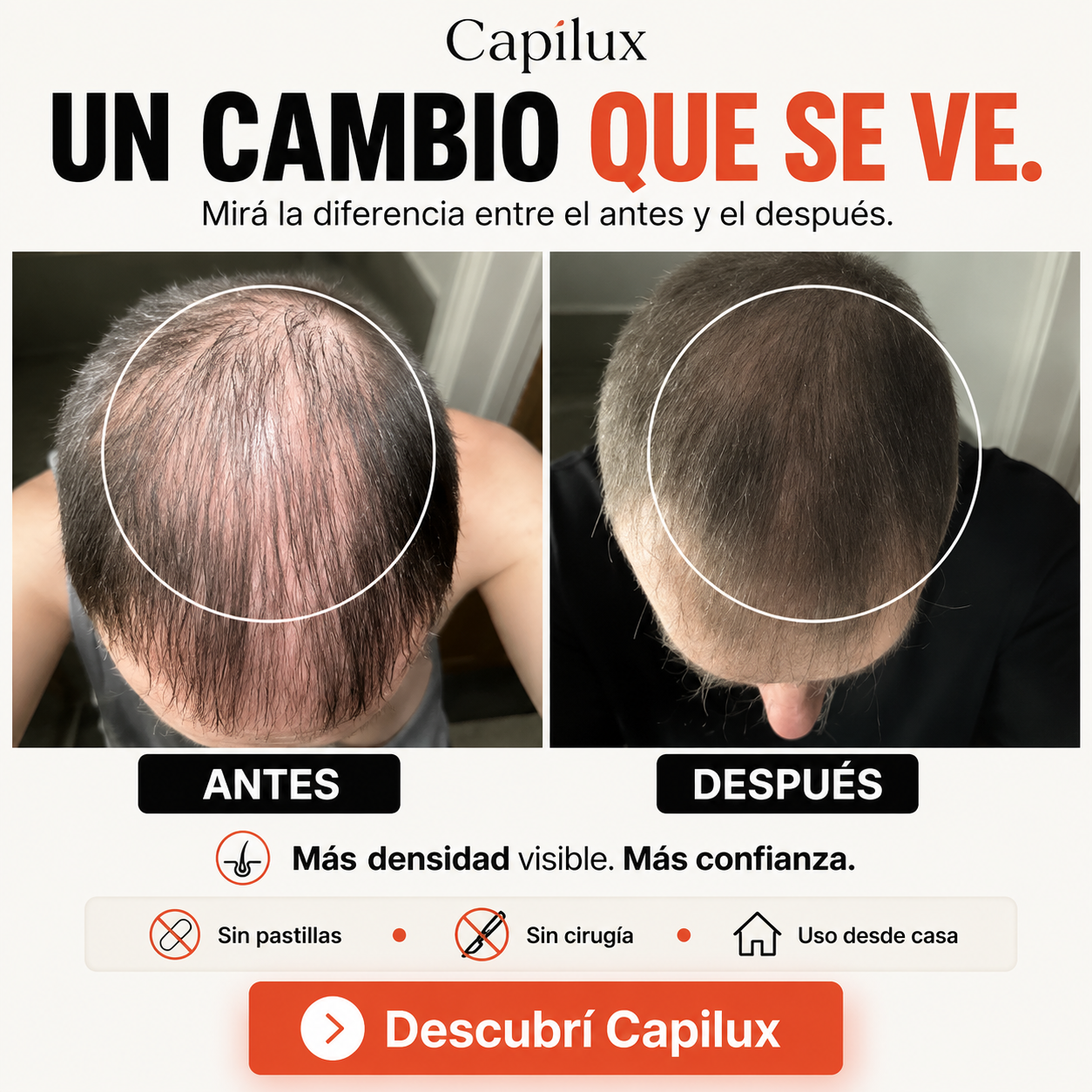 Capilux — tecnología de fotobiomodulación 660nm y 850nm para folículos capilares